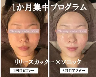 肩こり改善 筋膜リリースカッターのエステ・リラクイメージ