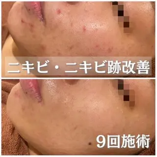 撲滅🔥 最短ニキビ改善のエステ・リラクイメージ