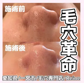 Reine BeautySalon所属・毛穴/シミ肝斑/脱毛 横山梨里のエステ・リラクイメージ