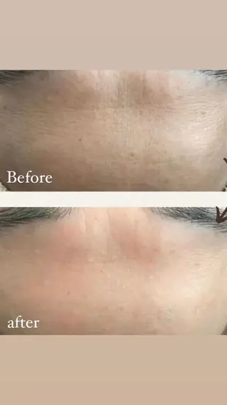 肌質改善ハーブピー リング🌿RINAのエステ・リラクイメージ