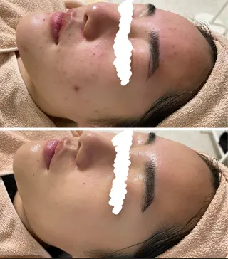 ニキビ&跡改善サロン オーナー光木のエステ・リラクイメージ