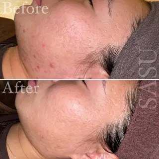 メンズ マツエク・マツパ アイブロウ 即小顔♥️美容鍼× ハーブピーリングのその他イメージ