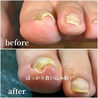 ネイル 巻き爪補正 Umber　Miyaのネイルデザイン