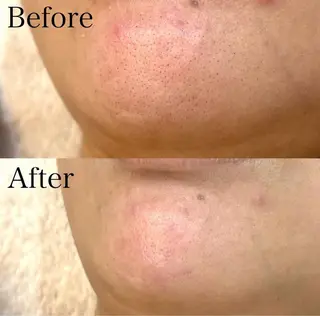 肌質改善ハーブ ピーリングBellaのエステ・リラクイメージ