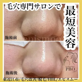 epismoo 脱毛/HBL/毛穴の眉毛・アイブロウイメージ