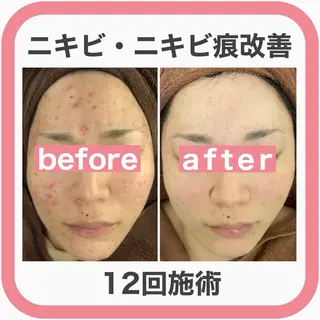 学生ニキビ改善🍀 優しい肌質改善のエステ・リラクイメージ