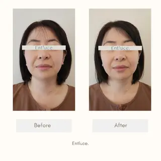 即効⚡小顔美容鍼🪡 むくみたるみ脂肪解消のエステ・リラクイメージ