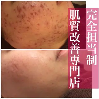 皮膚科より効果あり ⁉️最短ニキビ改善のエステ・リラクイメージ