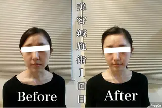 鍼灸整骨院Refine所属・鍼灸 Refineのその他イメージ