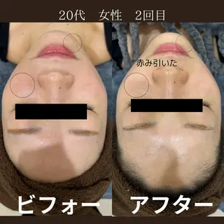 NiU.BEAUTY🥥池袋店所属・ハーブピーリング専門 NiU.BEAUTYのエステ・リラクイメージ