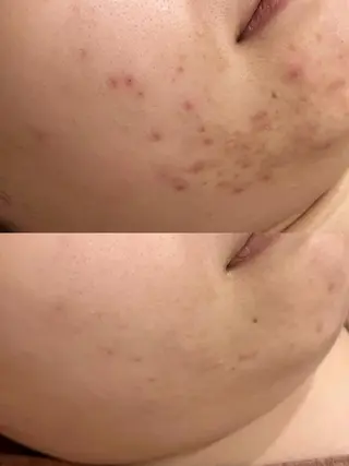 ニキビ特化型エステ 🍋最短で肌質改善のエステ・リラクイメージ