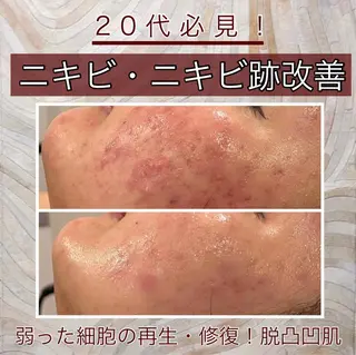 Meow！～トラブル肌専門ピーリング＆脱毛サロン～所属・トラブル肌改善🏥 Meow！🫧🫧のエステ・リラクイメージ