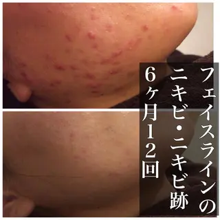 実績6万人🔥 超最速ニキビ改善のエステ・リラクイメージ
