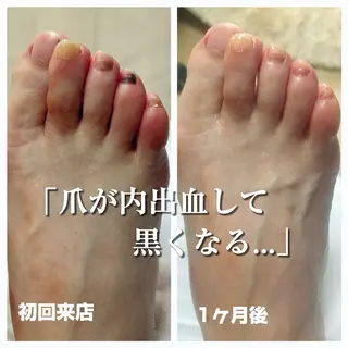 巻き爪フットケアサロンKotori所属・フットケアサロン Kotoriのその他イメージ