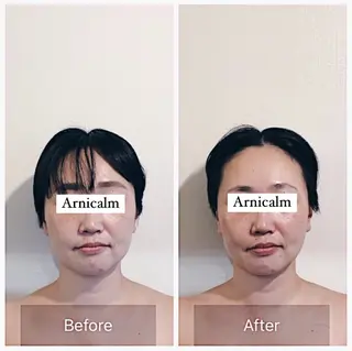 ハーブピーリング 肌再生ピーリング/のエステ・リラクイメージ