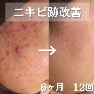 ダウンタイムなし✨ 敏感肌さん用エステのエステ・リラクイメージ