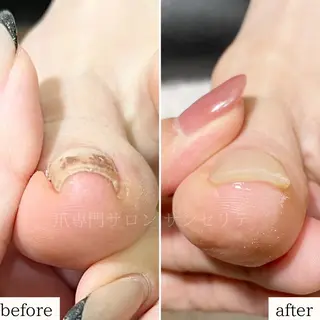 ネイル 深爪・巻き爪 専門サンセリテのネイルデザイン