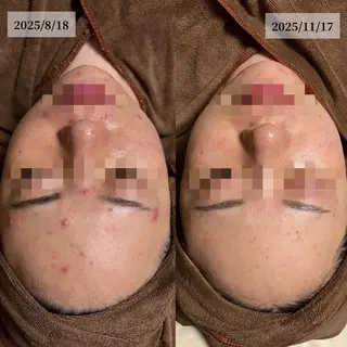 HINANO矢場町店【ヒナノ】所属・脱毛/肌改善🌿 HINANO 村田のエステ・リラクイメージ