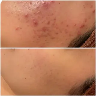来春までに脱・肌荒れ できるサロン✨のエステ・リラクイメージ