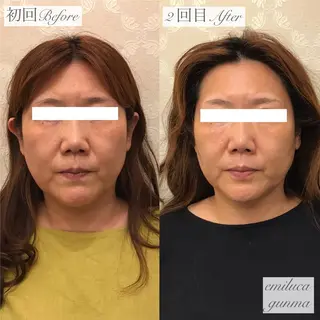 emiluca西目/ 毛穴洗浄/細胞美容のエステ・リラクイメージ