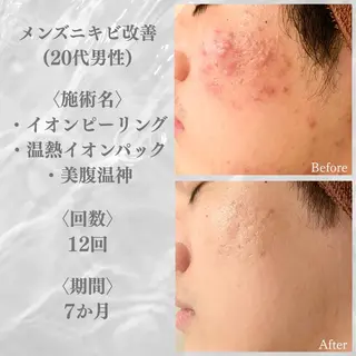 6万人の美肌実績🔥 最短ニキビ改善のエステ・リラクイメージ