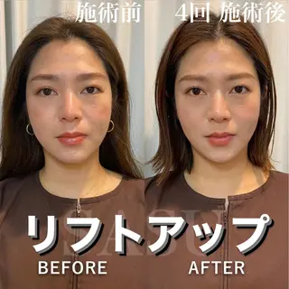 メンズ 即小顔♥️美容鍼× ハーブピーリングのその他イメージ