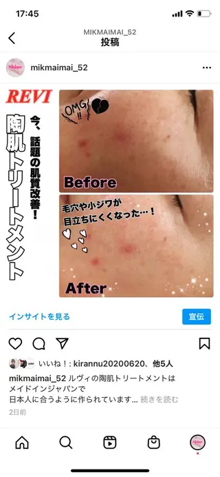 Chalon所属・REVI取扱・肌悩み 毛穴Chalonのエステ・リラクイメージ