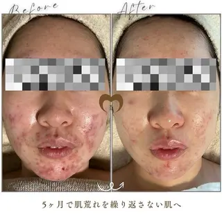 ニキビケア/肌質専門 悩まない肌に✨森園のエステ・リラクイメージ