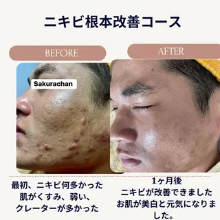 ニキビ、痩身、脱毛、 サクラチャンスパのエステ・リラクイメージ