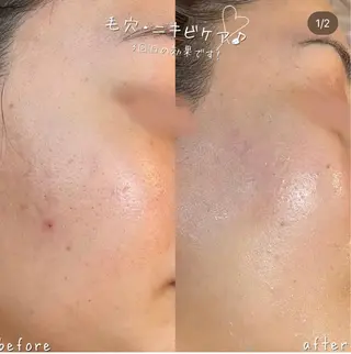 【ハーブピーリング/毛穴洗浄】NA skin 川崎店〜ニキビ・毛穴専門店〜所属・NAskin川崎 皆川のエステ・リラクイメージ