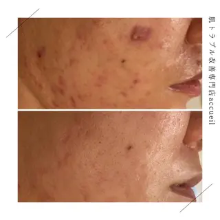 ショート カラー パーマ ヘアアレンジ メンズ キッズ ネイル マツエク・マツパ アイブロウ 触れたくなる モテ肌へ...❤︎のエステ・リラクイメージ