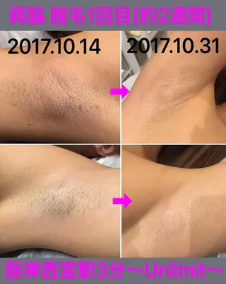 脱毛＆エステサロン【アンリミット】所属・森谷 莉美のエステ・リラクイメージ