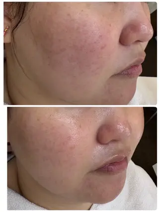 デ・アイム　西船橋所属・吉永玲奈 ニキビ/毛穴/シミのエステ・リラクイメージ