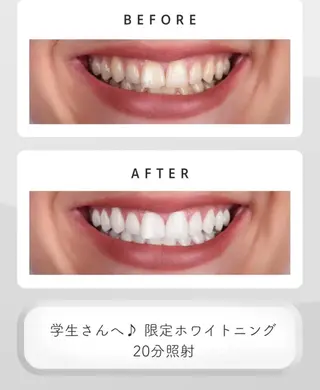 アイブロウ33🦷久留米店💫所属・ふみな セルフホワイトニングのその他イメージ