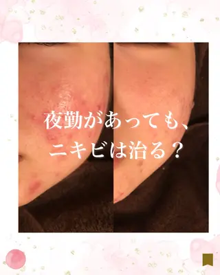 ニキビ跡専門サロン Ainaのエステ・リラクイメージ