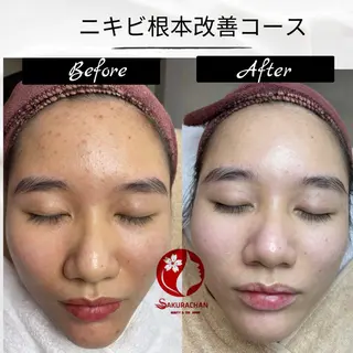 ニキビ、痩身、脱毛、 サクラチャンスパのエステ・リラクイメージ