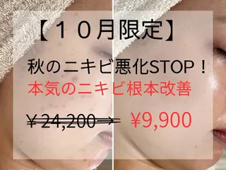 シェノン所属・毛穴/ニキビ/ ニキビ跡肌改善専門のエステ・リラクイメージ