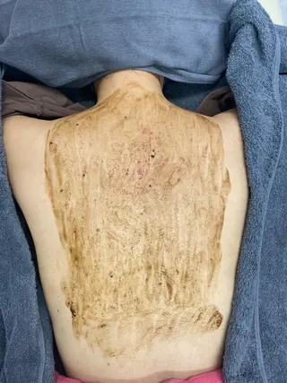 ニキビ特化美容鍼 ×ハーブピーリングのエステ・リラクイメージ