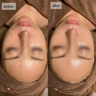 HINANO矢場町店【ヒナノ】所属・脱毛/肌改善🌿 HINANO 村田のエステ・リラクイメージ