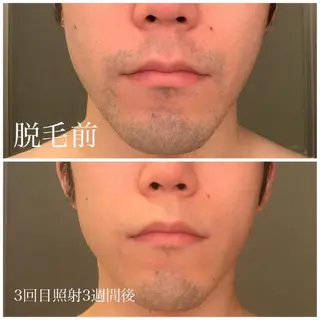 みんなの脱毛 TSURURINの眉毛・アイブロウイメージ