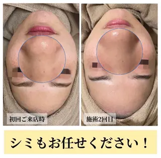 ハーブピーリング・毛穴ケア専門サロンSalon de LENA所属・ハーブピーリング 毛穴専門店/栄のエステ・リラクイメージ