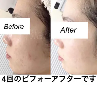 ミディアム カラー パーマ キッズ ネイル マツエク・マツパ 都度払い肌質改善 &脱毛Blancheのエステ・リラクイメージ