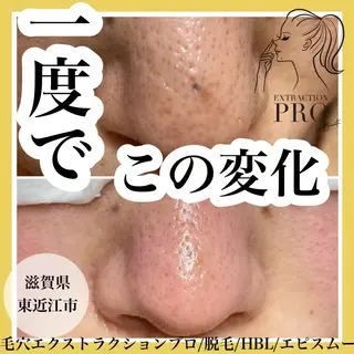 epismoo 脱毛/HBL/毛穴の眉毛・アイブロウイメージ