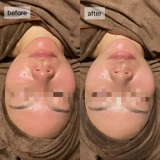 HINANO矢場町店【ヒナノ】所属・脱毛/肌改善🌿 HINANO 村田のエステ・リラクイメージ