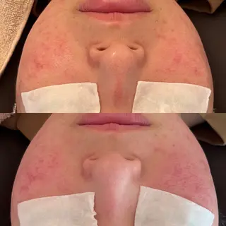 毛穴ケア/毛穴診断/ 毛穴洗浄〔心斎橋〕のエステ・リラクイメージ