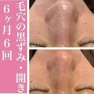 学生ニキビ改善🍀 優しい肌質改善のエステ・リラクイメージ