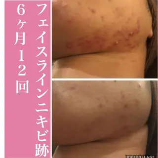 学生ニキビ改善🍀 優しい肌質改善のエステ・リラクイメージ