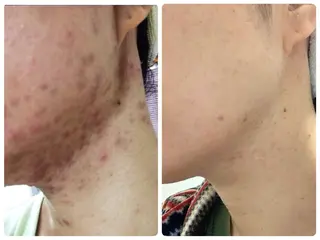 ニキビ・ 肌荒れ専門店のエステ・リラクイメージ