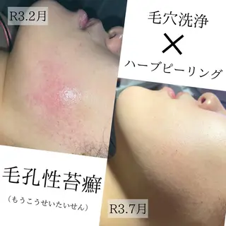 ハーブピーリング・毛穴ケア専門サロンSalon de LENA所属・ハーブピーリング 専門店/名古屋駅前店のエステ・リラクイメージ
