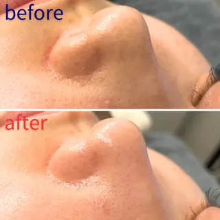 毛穴洗浄特化🫧 オオツカのエステ・リラクイメージ